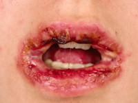 Stevens-Johnson syndroom