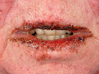 Stevens-Johnson syndroom