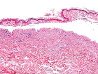 Toxische epidermale necrolyse (TEN)