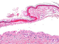 Toxische epidermale necrolyse (TEN)