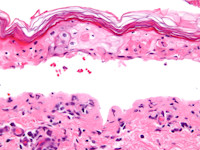 Toxische epidermale necrolyse (TEN)