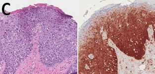 AIN-3 (anale intraepitheliale neoplasie graad 3)