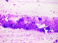 Tzanck test met multinucleate giant cells