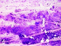 Tzanck test met multinucleate giant cells