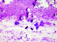 Tzanck test met multinucleate giant cells