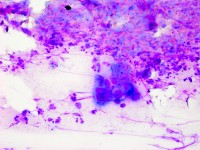 Tzanck test met multinucleate giant cells