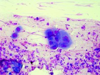 Tzanck test met multinucleate giant cells
