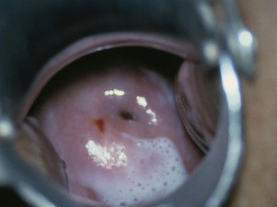 Bacterial vaginosis (Gardnerella vaginalis): foamy discharge with gas bubbles