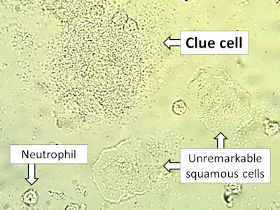 Clue cells