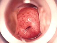 Colpitis macularis, aardbeien cervicitis bij Trichomoniasis