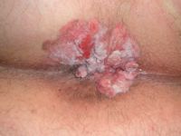 Condyloma acuminata