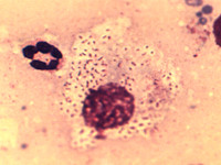 Granuloma inguinale