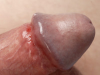 Lues (syfilis) stadium 1, erosie