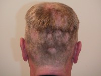 Lues 2, secundaire syfilis