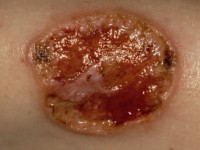 Lues 2, secundaire syfilis