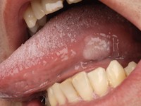 Lues 2, secundaire syfilis