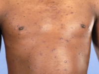 Lues 2, secundaire syfilis