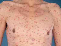 Lues 2, secundaire syfilis