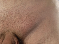 LGV: Lymfogranuloma venereum