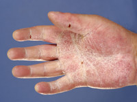 Schopf-Schulz-Passarge syndroom