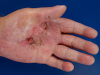 Schopf-Schulz-Passarge syndroom