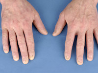 Schopf-Schulz-Passarge syndroom