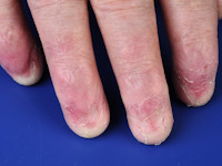 Schopf-Schulz-Passarge syndroom