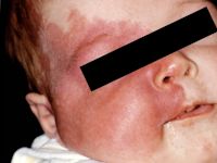 Sturge Weber syndroom