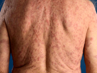 Histiocytoïde Sweet bij myelodysplastisch syndroom