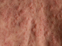 Histiocytoïde Sweet bij myelodysplastisch syndroom