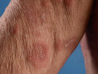 Histiocytoïde Sweet bij myelodysplastisch syndroom