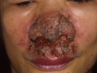 Ulcerating midline lymphoma (ULM)