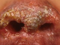 Ulcerating midline lymphoma (ULM)