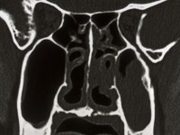 Ulcerating midline lymphoma (ULM)