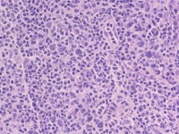 Ulcerating midline lymphoma (ULM)