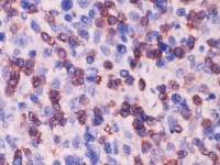 Ulcerating midline lymphoma (ULM)