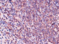 Ulcerating midline lymphoma (ULM)