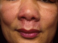 Ulcerating midline lymphoma (ULM)