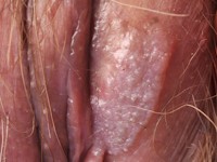 Vulvaire high grade squamous intra-epithelial lesion