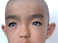 Poliosis circumscripta