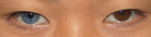 Poliosis circumscripta