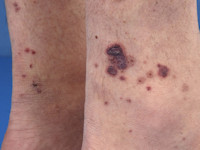 Ulcera bij ziekte van Wegener