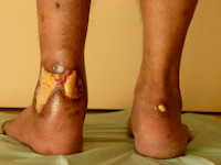 Ulcera bij ziekte van Wegener