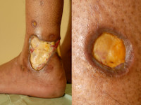 Ulcera bij ziekte van Wegener