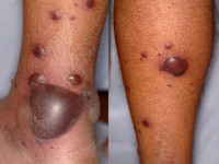 Ulcera bij ziekte van Wegener