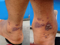 Ulcera bij ziekte van Wegener