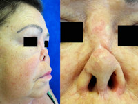 Ingezakte neus (zadelneus) bij ziekte van Wegener