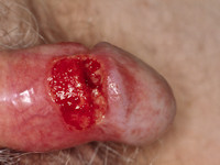 Ulcera bij ziekte van Wegener