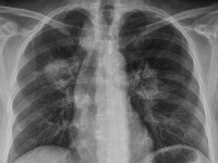 Longafwijkingen bij ziekte van Wegener