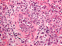 PA ziekte van Wegener